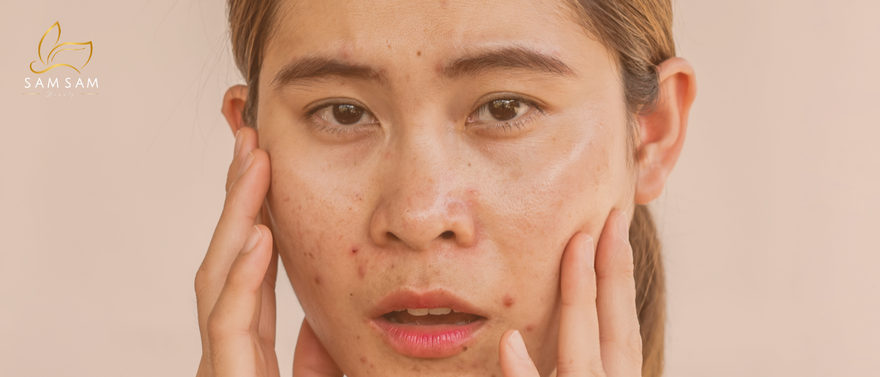 삼삼뷰티가 제안하는 화농성 여드름 예방을 위한 여름철 지성 피부 관리 방법 5가지