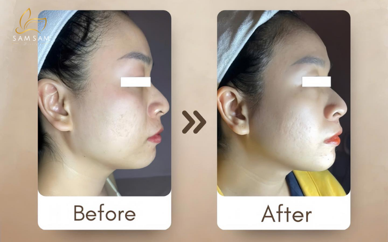 샘샘뷰티 호치민 하이푸 울트라포머 3 전후 사진 - 즉각적인 이중턱 개선 및 V라인 효과