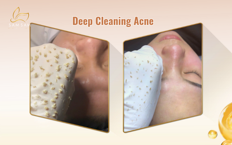 Kết quả sau liệu trình lấy nhân mụn chuẩn y khoa tại Sam Sam giúp da sạch sâu và giảm thâm 