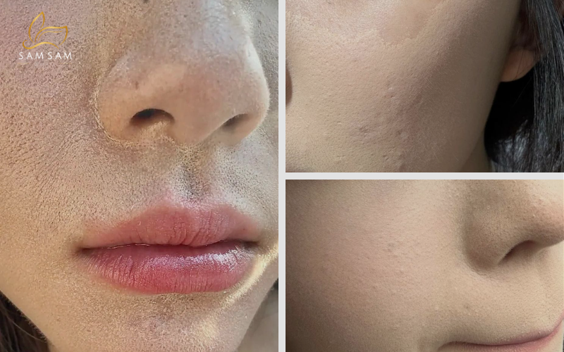 Lớp nền bị mốc, sần sùi do nhiều nguyên nhân như kỹ thuật makeup, dưỡng ẩm không đủ hoặc do mụn ẩn gây ra