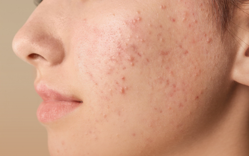 Các lý do phổ biến gây nổi mụn