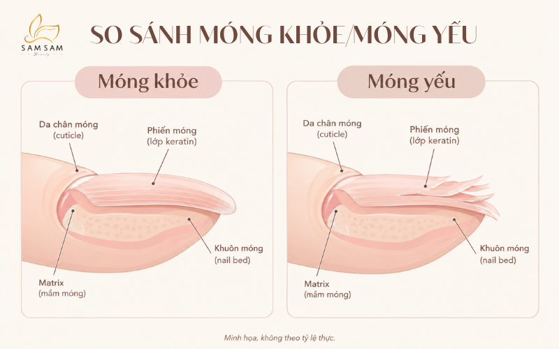 Sơ đồ so sánh lớp keratin móng khỏe xếp chặt và móng yếu bị tách lớp ở phần rìa